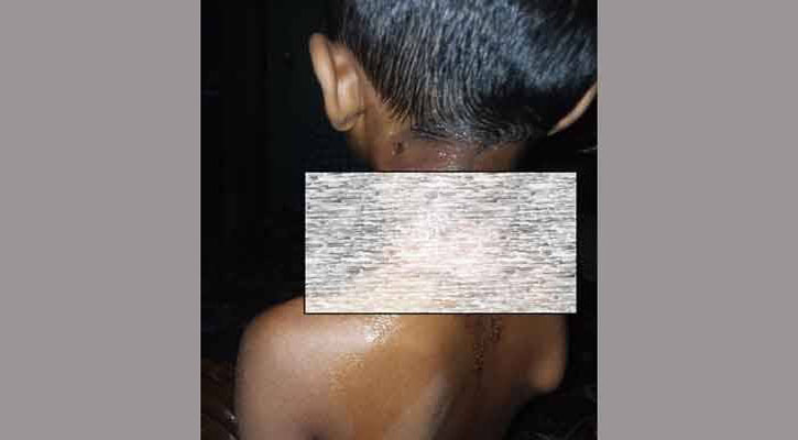 গরম চা ঢেলে শিশুর গলা ঝলসে দিলেন মক্তবের শিক্ষক