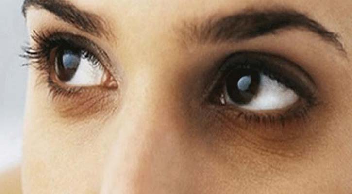 চোখের নিচে কালো দাগ দূর করবেন যেভাবে