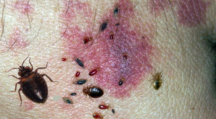 রক্তচোষা ছারপোকা থেকে বাঁচার উপায়